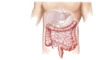 Divertikulit och divertikulos